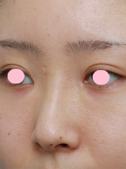 症例写真,他院で鼻に注入されたアクアミドを除去した症例写真,After(1週間後),ba_hanaaquamid02_b.jpg