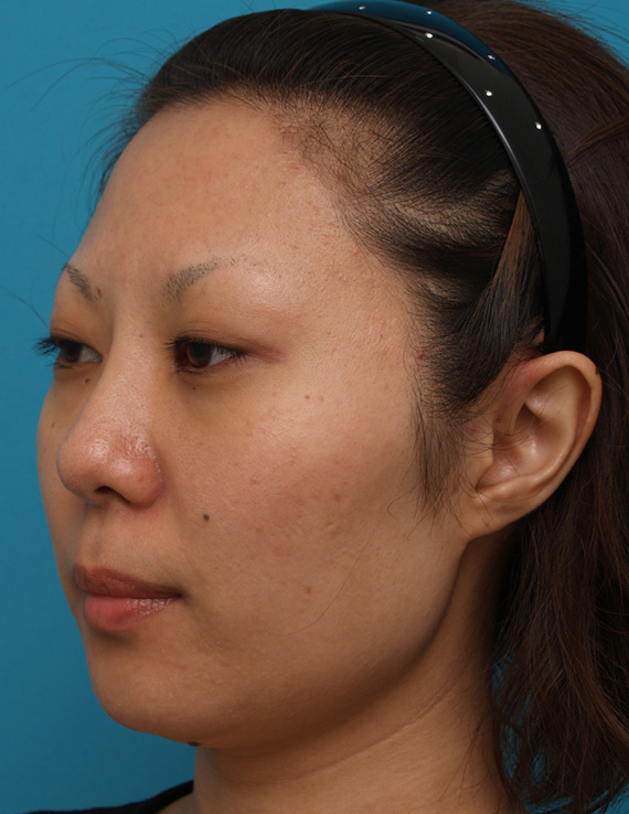 症例写真,20代の方に施術した金の糸(ゴールデンリフト)症例写真,Before,ba_goldlift_pic12_b.jpg