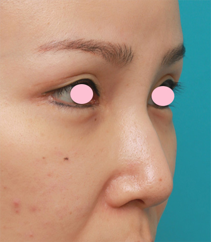 症例写真,他院で鼻にエンドプロテーゼ(エンドプラスト)を入れてデコボコになってしまい除去した症例写真,After(1ヶ月後),ba_modify02_b.jpg