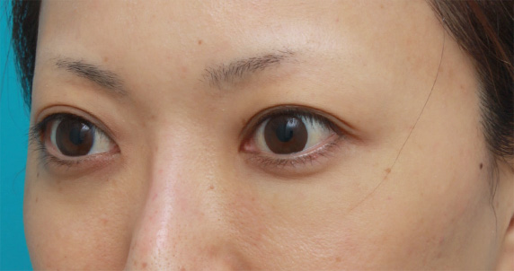 他院で受けた手術の修正(二重まぶた・目もと),他院で目の下に質の悪いヒアルロン酸を注射され凸凹になり、ヒアルロニダーゼで改善させた症例写真,Before,ba_hyaluronjyokyo06_b.jpg