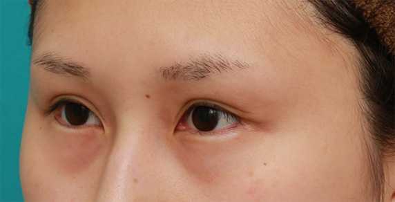 症例写真,他院で涙袋にヒアルロン酸注射をし、不自然に広がってしまったので、ヒアルロニダーゼで分解吸収させた症例写真の術前術後画像,After(1週間後),ba_hyaluronjyokyo10_b.jpg