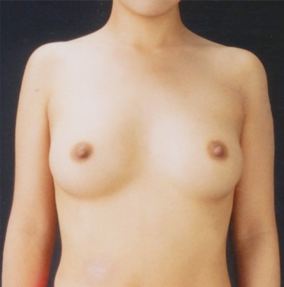 症例写真,豊胸手術(シリコンプロテーゼ)の症例写真 乳腺下に220CCずつ挿入,After,ba_hokyo29_b.jpg