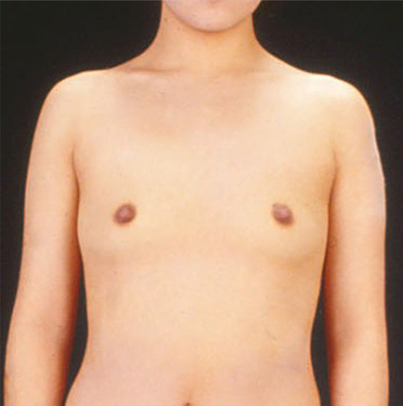 症例写真,豊胸手術(シリコンプロテーゼ)の症例写真 乳腺下に220CCずつ挿入,Before,ba_hokyo29_b.jpg