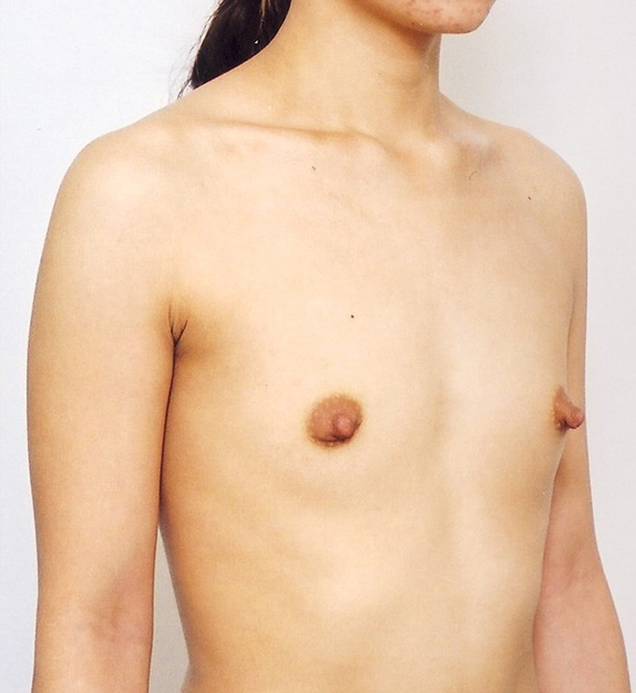 症例写真,豊胸手術(シリコンプロテーゼ)の症例 左右それぞれ200CCの挿入,Before,ba_hokyo27_b.jpg