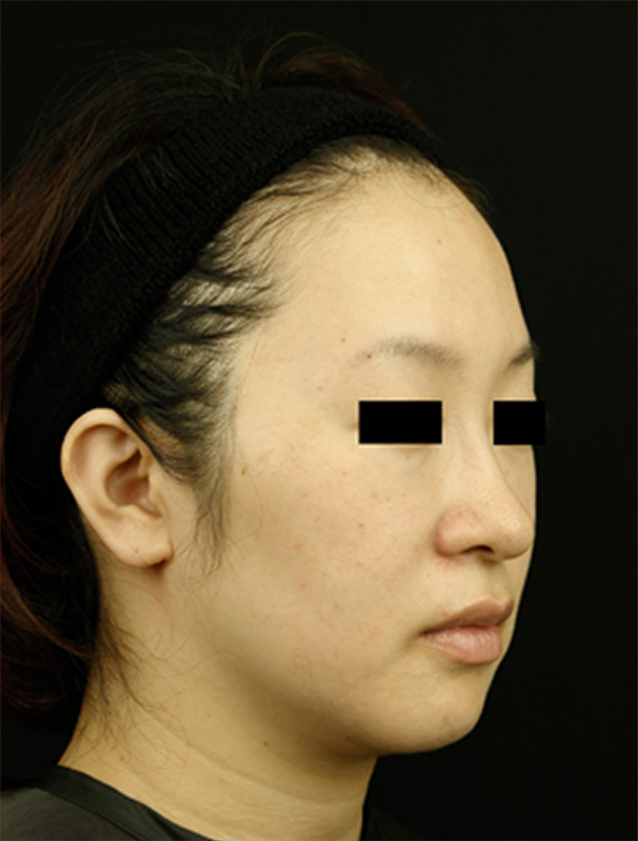 トリニティプラス/eプラス,トリニティプラス/eプラスの症例写真,After(3ヶ月後),ba_eplus03_b.jpg