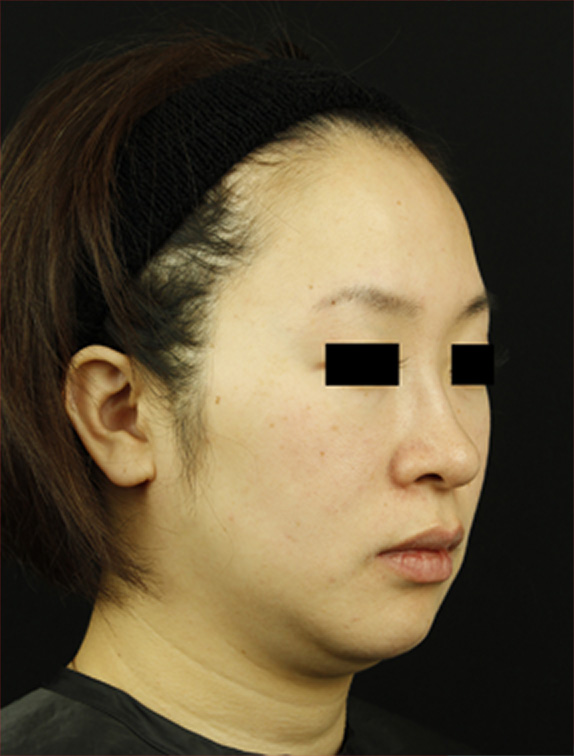 トリニティプラス/eプラス,トリニティプラス/eプラスの症例写真,Before,ba_eplus03_b.jpg