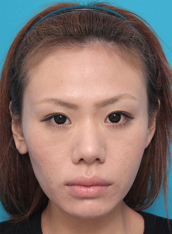 症例写真,20代(後半)女性にウルセラシステム+ボツリヌストキシン注射(エラ、プチ小顔術)を行い、輪郭がかなりシャープになった症例写真,After(メイクあり)<br/>
(3ヶ月後),