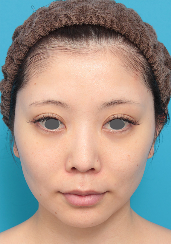症例写真,20代女性にウルセラシステムを行い、頬のたるみが引き締まり小顔になった症例写真,After(3ヶ月後),ba_ulthera15_b.jpg