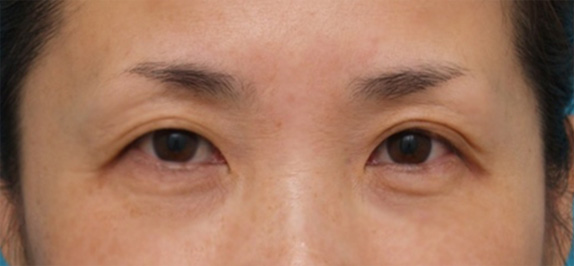 症例写真,サーマクールアイで目の周りの小じわが改善し、わずかに二重の幅が広がり、目が大きくなった症例写真,After(2ヶ月後),ba_thermacool_eye06_b.jpg