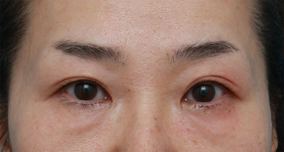 症例写真,サーマクールアイで目の開きが良くなった症例写真の術前術後画像の解説,After(2ヶ月後),ba_thermacool_eye07_b.jpg