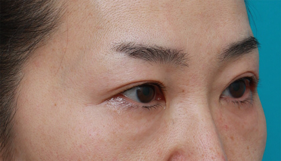 症例写真,サーマクールアイで目の開きが良くなった症例写真の術前術後画像の解説,After(2ヶ月後),ba_thermacool_eye08_b.jpg
