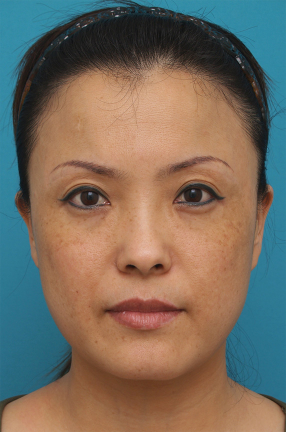 症例写真,40代女性に行ったサーマクール症例写真,After(3ヶ月後),ba_thermacool_pic27_b.jpg