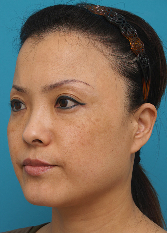 症例写真,40代女性に行ったサーマクール症例写真,After(3ヶ月後),ba_thermacool_pic28_b.jpg