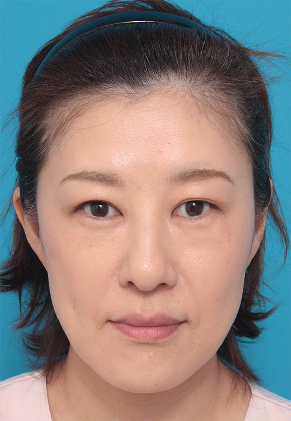 症例写真,40代女性の顔と首にサーマクールを照射した症例写真,After(3ヶ月後),ba_thermacool_pic29_b.jpg