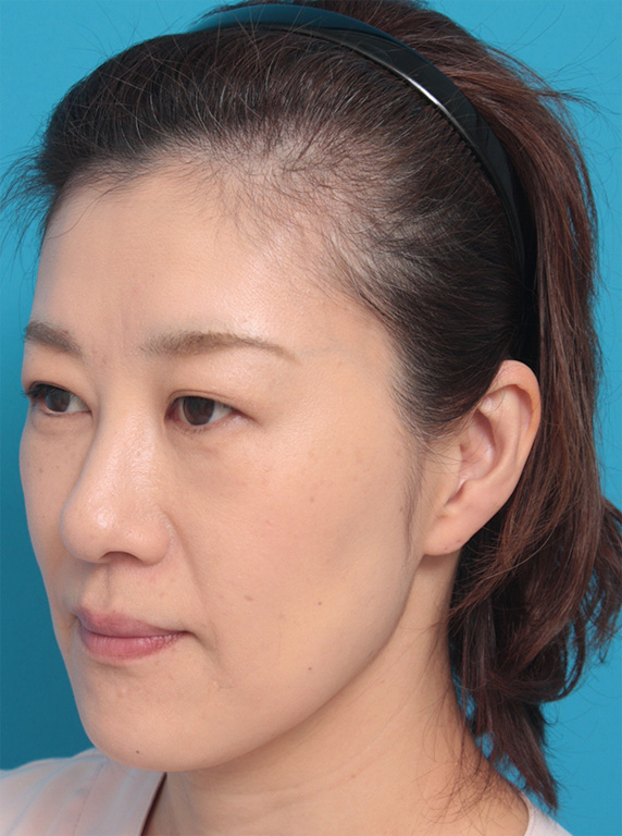 症例写真,40代女性の顔と首にサーマクールを照射した症例写真,After(3ヶ月後),ba_thermacool_pic30_b.jpg