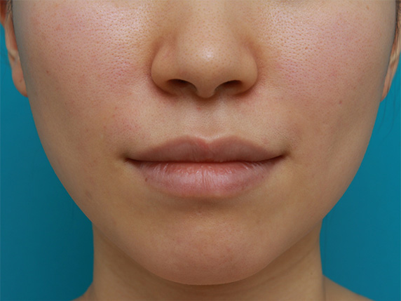 20代前半の女性の法令線にヒアルロン酸注射した症例写真,After,ba_hyaluronic_pic33_a01.jpg