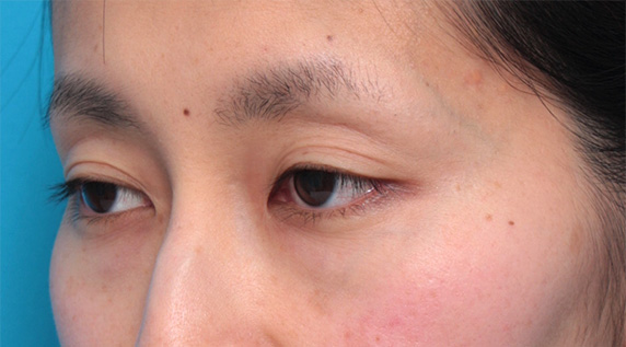 くぼみ目修正(ヒアルロン酸注射),上まぶたのくぼみにヒアルロン酸を注射し、二重のラインをはっきりさせた症例写真,Before,ba_hyaluronic_pic36_b.jpg