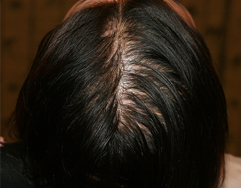 女性の薄毛治療,女性の薄毛治療(HARG療法)の症例 HARG療法を5回施術,Before,ba_aga_17_b.jpg