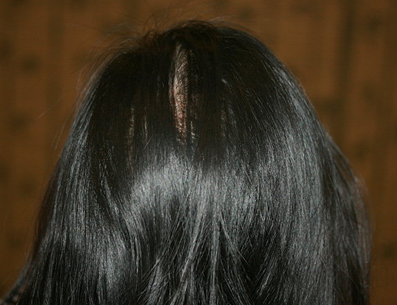 症例写真,女性の薄毛治療(HARG療法)の症例写真,After(4回施術 6ヶ月後),ba_aga_14_b.jpg