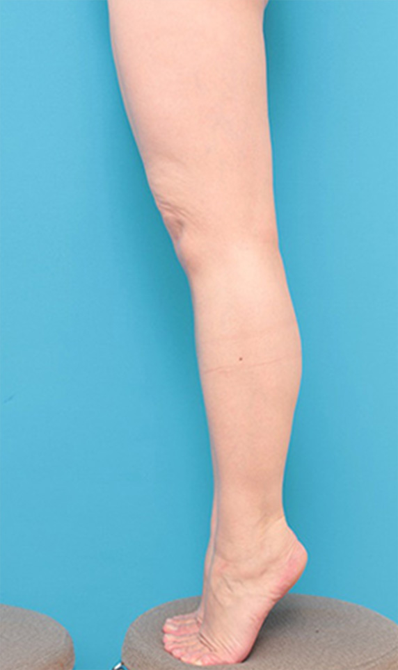 症例写真,ボツリヌストキシン注射(ふくらはぎ・足やせ・美脚)の症例,Before,ba_leg18_b.jpg
