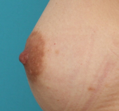 乳頭縮小,乳頭縮小の症例 胸のバランスに比べ乳頭が大きいことを気にされていた女性,After,ba_nyuto21_a01.jpg