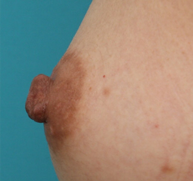 乳頭縮小,乳頭縮小の症例 胸のバランスに比べ乳頭が大きいことを気にされていた女性,Before,ba_nyuto21_b.jpg