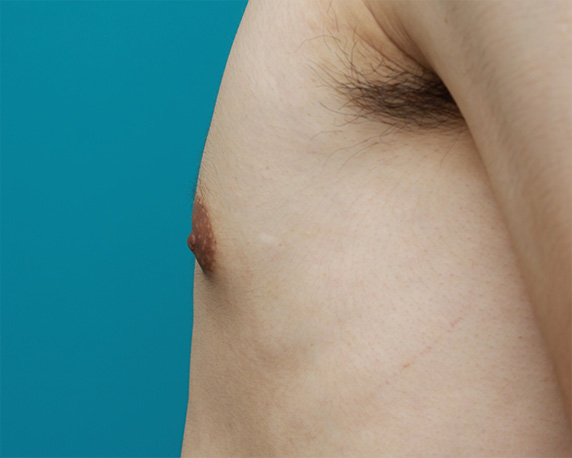 症例写真,男性の乳頭縮小手術の症例写真,After(1ヶ月後),ba_nyuto24_b.jpg