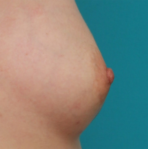 症例写真,乳頭縮小の症例 バストの脂肪注入手術と同時に乳頭縮小も施術,After(4ヶ月後),ba_nyuto26_b.jpg