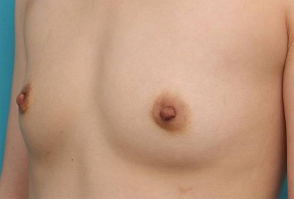 症例写真,乳頭縮小 妊娠、出産、授乳を繰り返し伸びてしまった乳首の症例,After(2週間後),ba_nyuto29_b.jpg