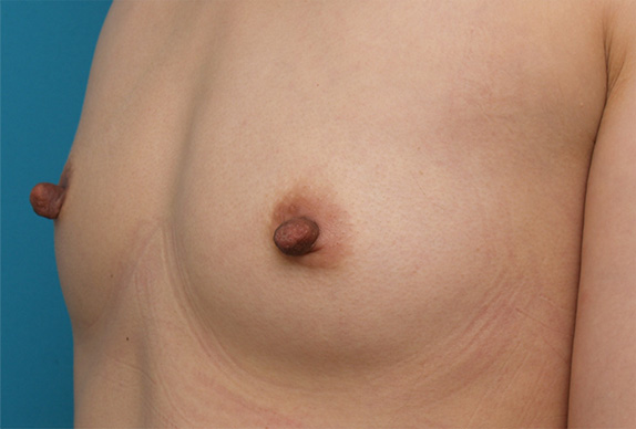 症例写真,乳頭縮小 妊娠、出産、授乳を繰り返し伸びてしまった乳首の症例,Before,ba_nyuto29_b.jpg