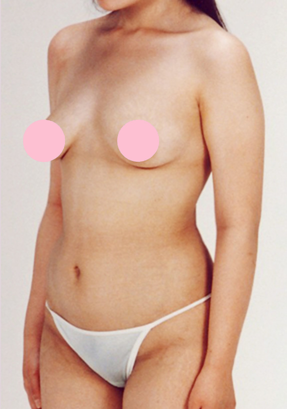 症例写真,脂肪吸引の症例写真 腹部,After,ba_shibokyuin27_b.jpg