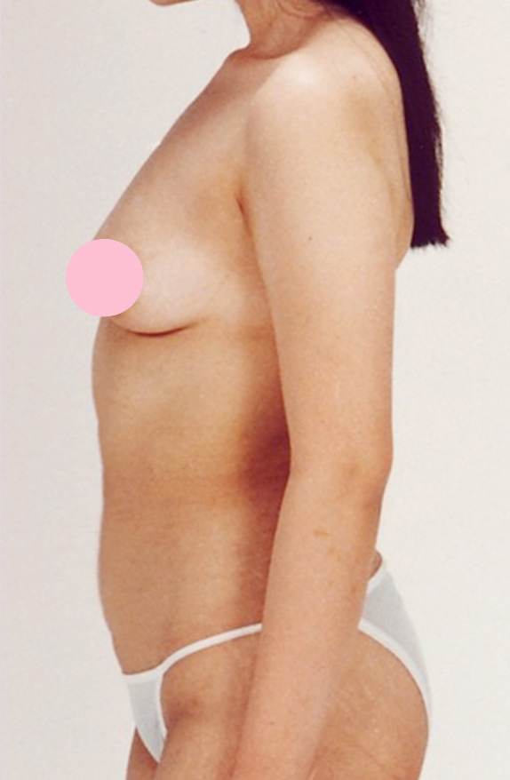 症例写真,脂肪吸引の症例写真 腹部,After,ba_shibokyuin28_b.jpg