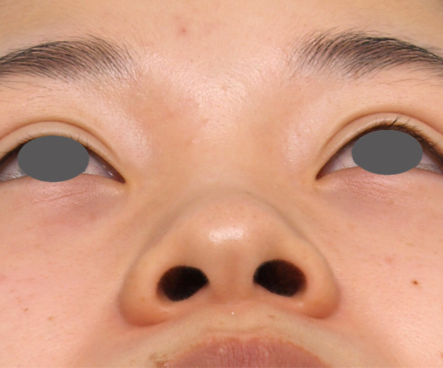 耳介軟骨移植(鼻先を出す),鼻プロテーゼ+耳介軟骨移植+鼻翼縮小症例写真,Before,ba_bisen15_b.jpg