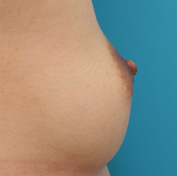 症例写真,乳頭縮小手術でやや大きめな乳首を小さめにした症例写真の術前術後画像,After(3ヶ月後),ba_nyuto33_b.jpg