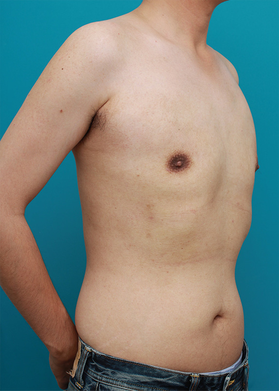症例写真,乳腺除去と脂肪吸引を併用した女性化乳房の手術症例写真,After(3ヶ月後),ba_gynecomastia23_b.jpg