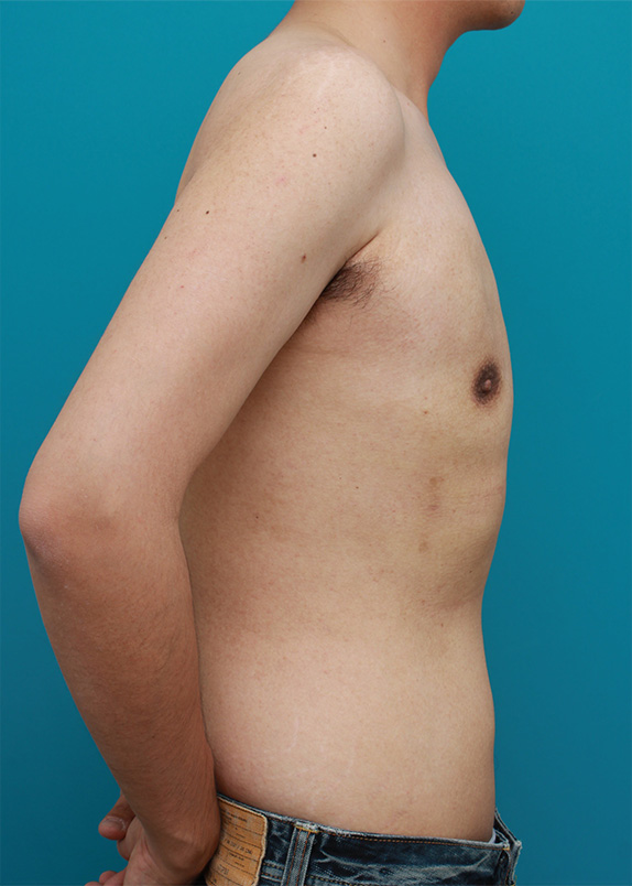症例写真,乳腺除去と脂肪吸引を併用した女性化乳房の手術症例写真,After(3ヶ月後),ba_gynecomastia24_b.jpg