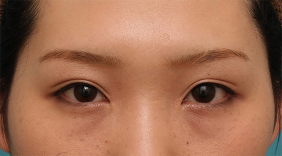 二重まぶた・全切開法,目頭切開+二重まぶた全切開法で、幅が広すぎなく適度な狭さの平行型二重を作った症例写真の術前術後画像,After(メイクあり)<br/>
(6ヶ月後,