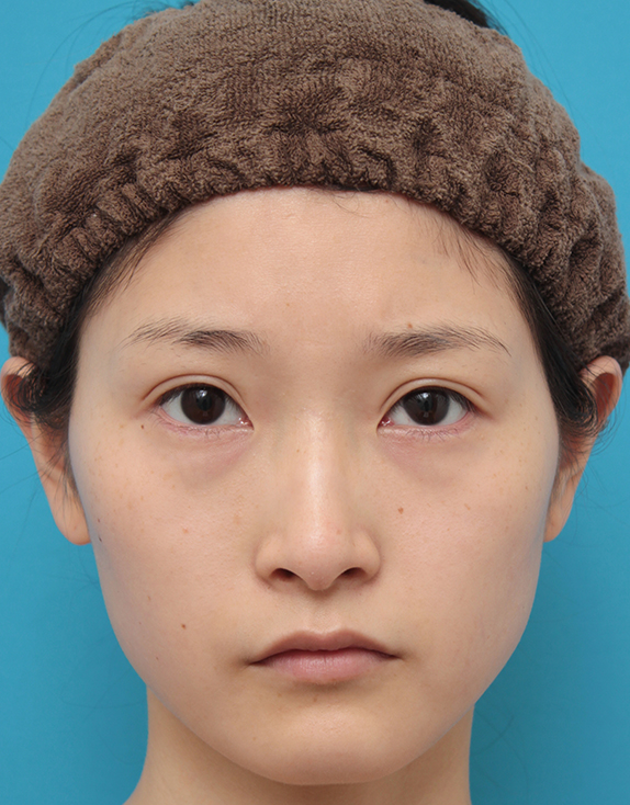 症例写真,二重まぶた全切開法とタレ目形成(グラマラスライン)を同時に行い、キツい目を優しい感じの印象に変えた症例写真の術前術後画像,After(目を開けた状態),ba_sekkai53_b.jpg