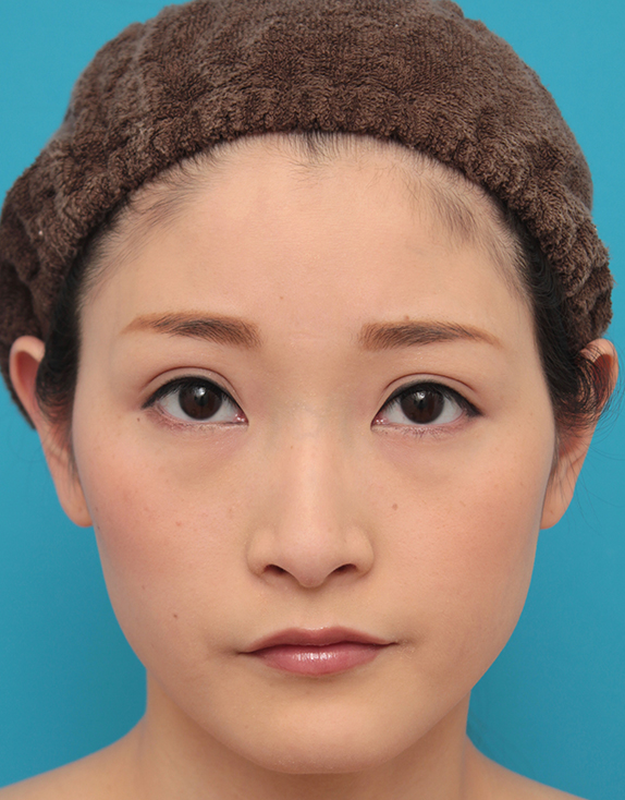 症例写真,二重まぶた全切開法とタレ目形成(グラマラスライン)を同時に行い、キツい目を優しい感じの印象に変えた症例写真の術前術後画像,After(メイクあり)<br/>
(6ヶ月後),