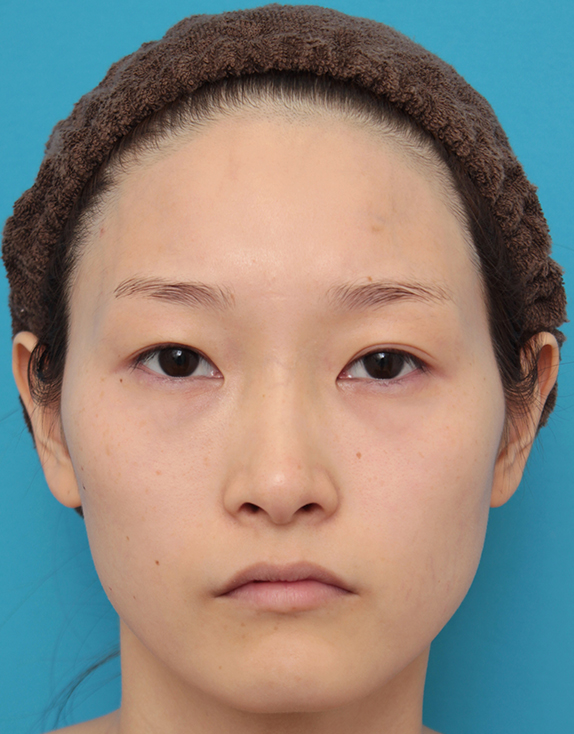 症例写真,二重まぶた全切開法とタレ目形成(グラマラスライン)を同時に行い、キツい目を優しい感じの印象に変えた症例写真の術前術後画像,Before,ba_sekkai53_b.jpg