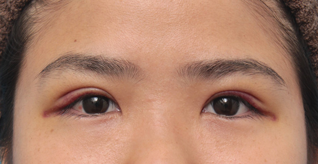 二重まぶた・全切開法,二重まぶた埋没法と同じラインで全切開法をした症例写真の術前術後画像,6日後,mainpic_sekkai34c.jpg