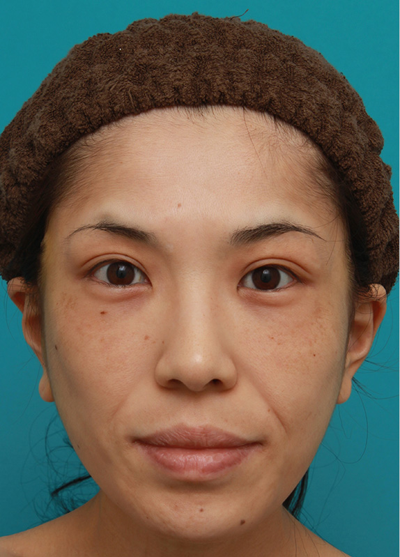 症例写真,ミディアムフェイスリフトで頬のたるみを改善し、法令線が浅くなった30代女性の症例写真,After,ba_mediumlift006_b01.jpg