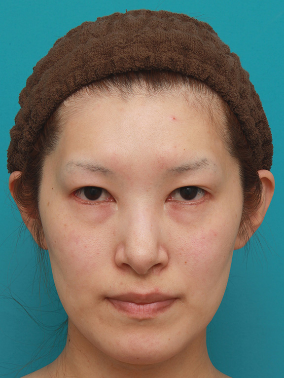目尻切開+タレ目形成（グラマラスライン）で外斜視気味の目を改善させた症例写真の術前術後画像,After（6ヶ月後）,ba_panda016_a01.jpg