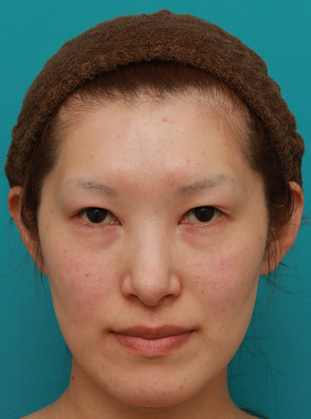 症例写真,目尻切開+タレ目形成(グラマラスライン)で外斜視気味の目を改善させた症例写真の術前術後画像,手術前,mainpic_panda016a.jpg