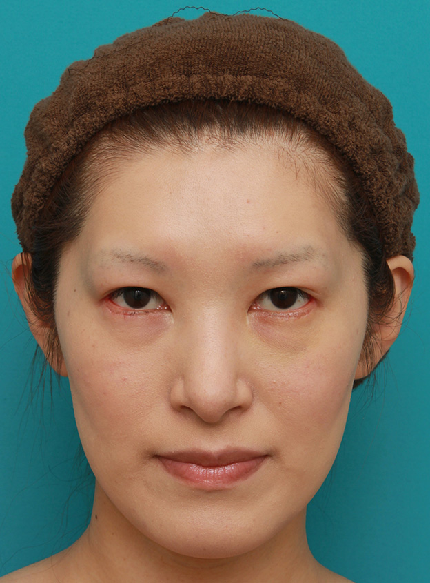 症例写真,目尻切開+タレ目形成(グラマラスライン)で外斜視気味の目を改善させた症例写真の術前術後画像,1週間後,mainpic_panda016c.jpg
