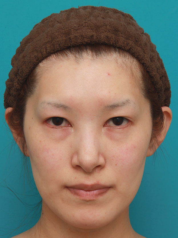 症例写真,目尻切開+タレ目形成(グラマラスライン)で外斜視気味の目を改善させた症例写真の術前術後画像,6ヶ月後,mainpic_panda016d.jpg