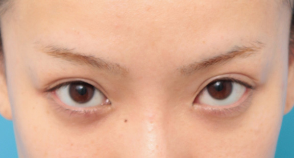 二重まぶた・全切開法,目頭切開、目尻切開、二重まぶた全切開法、目の下脂肪取りを同時に行った症例,After(9ヶ月後)<br/>
(顎を引いて睨んだ状態),ba_sekkai044_b02.jpg