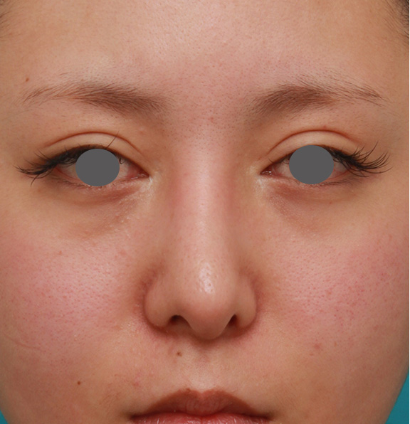 症例写真,他院で受けたゴアテックス+鼻中隔延長を自然な形に修正した症例の術前術後画像,After(修正手術前)
他院で手術をした3週間後,ba_nose_modify015_b01.jpg