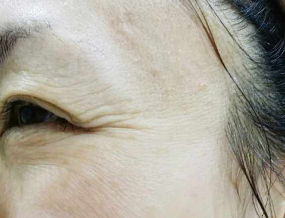 症例写真,水光注射(ダーマシャイン・バランス(R))の症例写真,After,ba_dermashine001_b01.jpg
