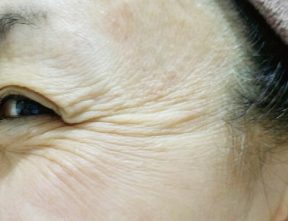 症例写真,水光注射(ダーマシャイン・バランス(R))の症例写真,Before,ba_dermashine001_b01.jpg